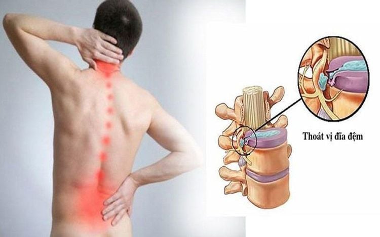 Triệu chứng thường gặp